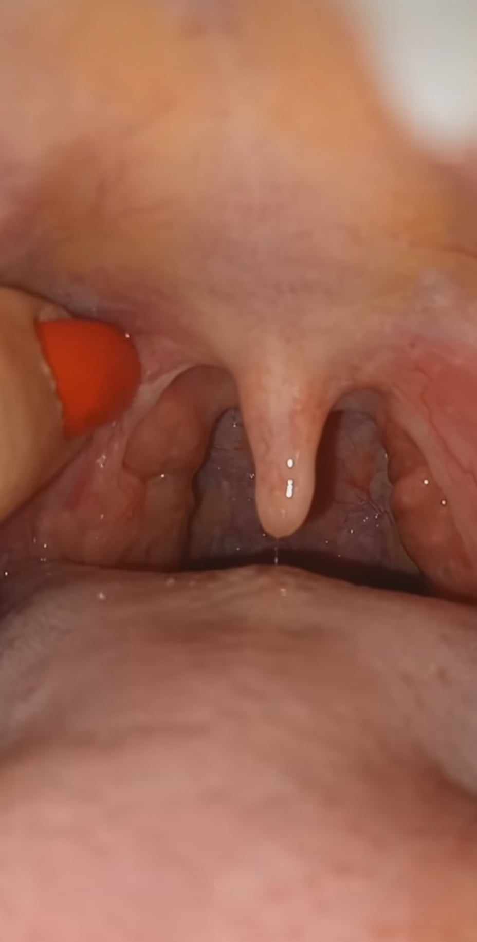 What are tonsil stones?(VIDEO)