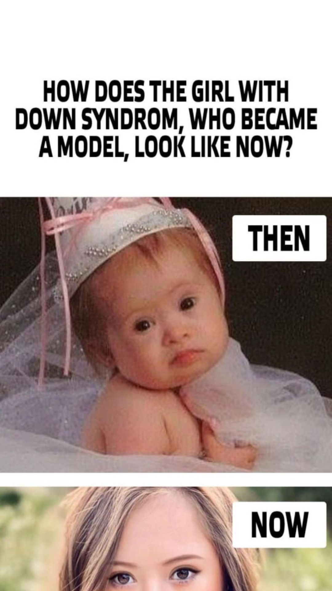 The mother was given the option of giving up her Down syndrome child, but she refused, and the child later became a model.