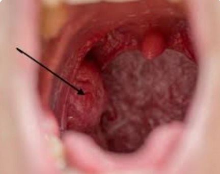 Here’s what you need to know about tonsil stones – the weird pimple-like growths in your throat
