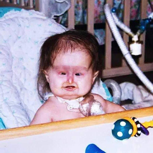 Baby Born With Unusual Syndrome – 22 Years Later She Looks Amazing