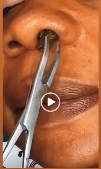 The Satisfying Science Behind Pimple Popping: Why We Can’t Look Away