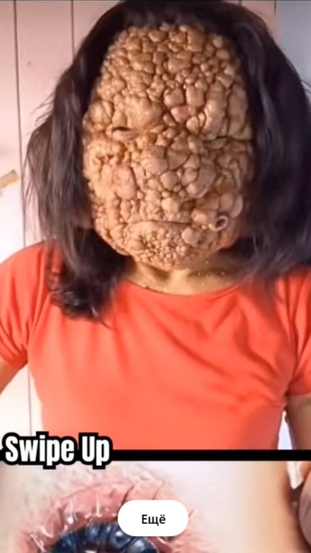Acne occurs when hair follicles become clogged.